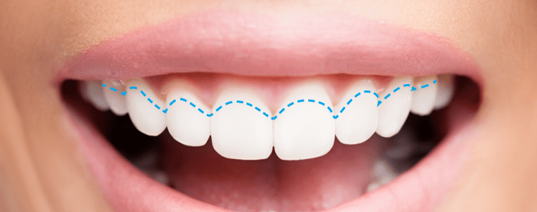 Receding Gums