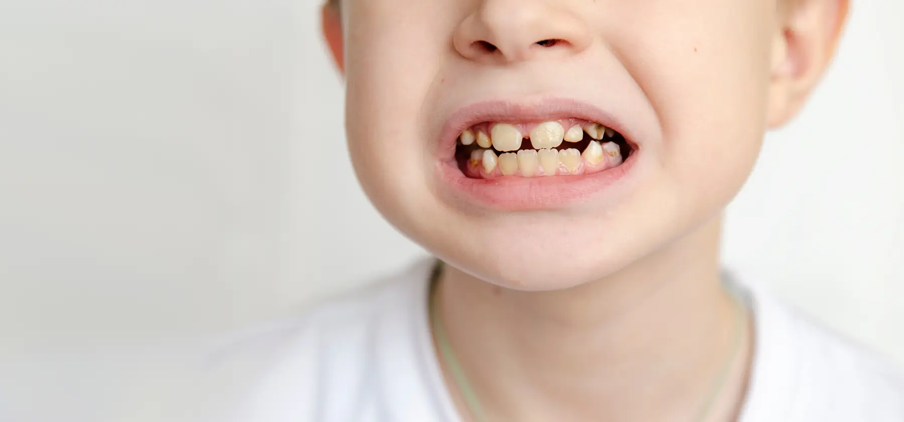Teeth Whitening